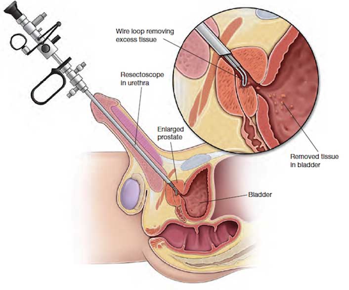 prostate gland surgery)