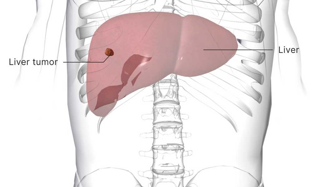 Liver tumor treated nonsurgically byRFA, TACE & TARE