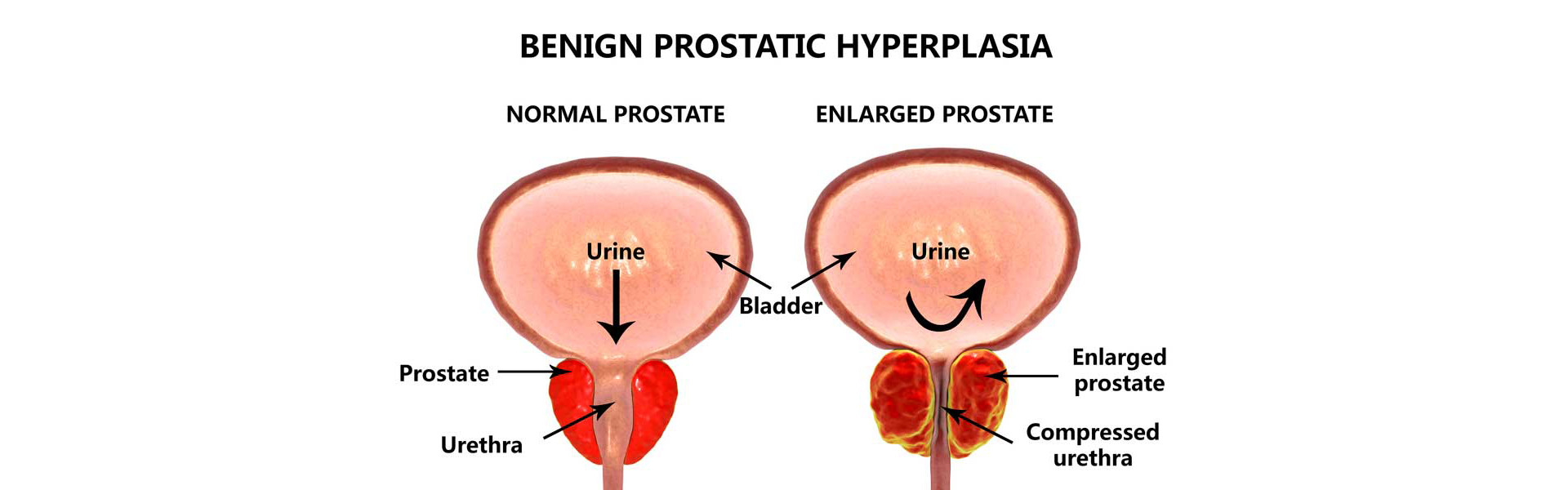 unilateral prostate enlargement