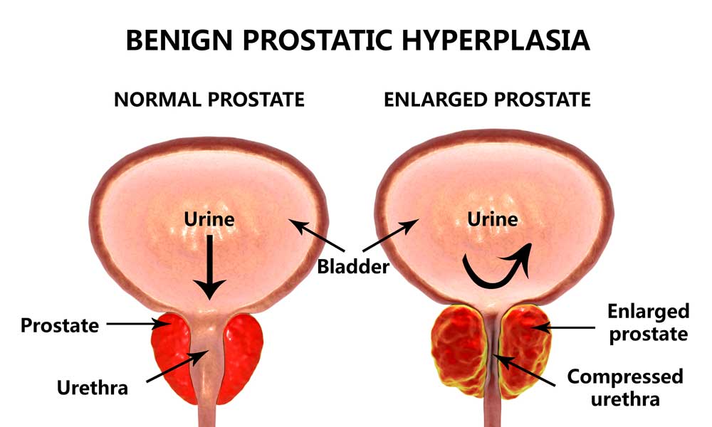 unilateral prostate enlargement)